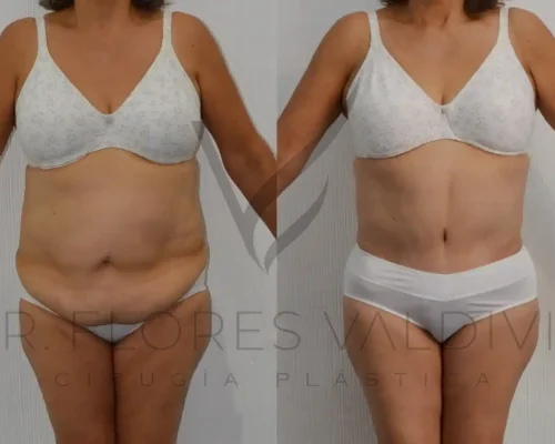 Abdominoplastia