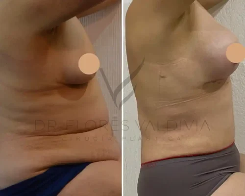 Abdominoplastia