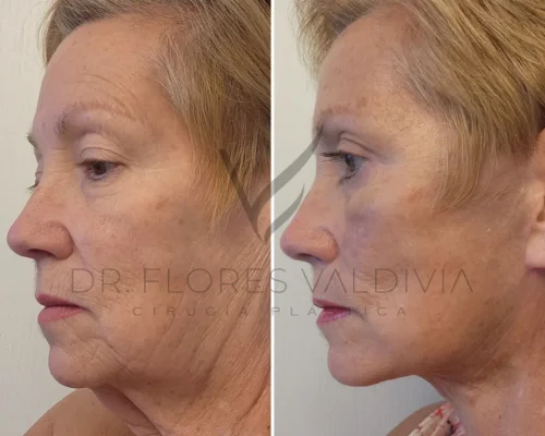 Side-by-side comparison of an older woman's face before and after a cosmetic procedure. The left image shows sagging skin, and the right image shows tightened and smoother skin. "Dr. Flores Valdivia" text is visible.