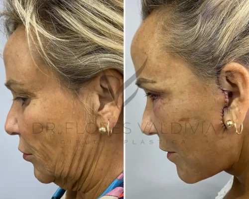 Side-by-side comparison of a woman's face showing before (left) and after (right) results of a cosmetic surgery procedure.