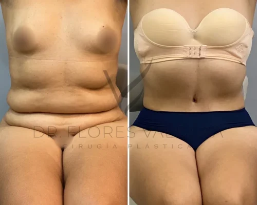 Before and after image of a person showing the results of an abdominal contouring procedure. The left side shows the body before surgery with excess skin, and the right side shows a toned, post-surgery abdomen.