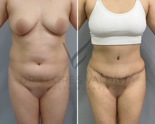 Side-by-side comparison of a woman before and after plastic surgery, showing changes in body contour, wearing underwear and a bra in the after photo.