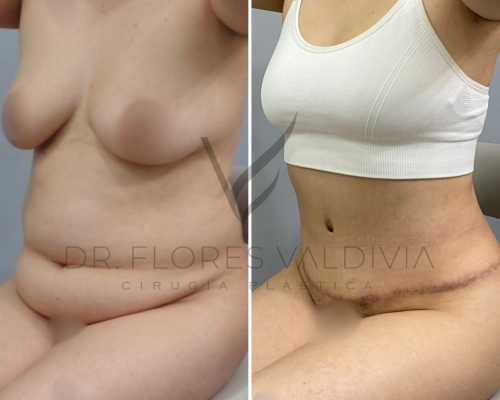 Side-by-side before and after photos of a woman seated, showing body changes and a surgical scar, likely following an abdominoplasty procedure.
