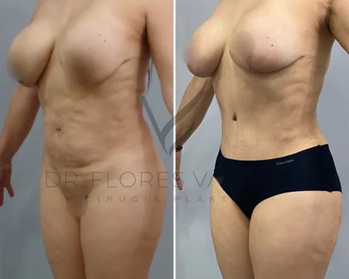 Two side-by-side photos of a woman's torso showing before and after results of a cosmetic surgery. The left image shows a less toned abdomen and larger waistline, and the right shows a more toned abdomen.