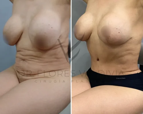Side-by-side comparison of a woman’s torso showing before and after results of a cosmetic surgery, with noticeable skin tightening and abdominal contouring.