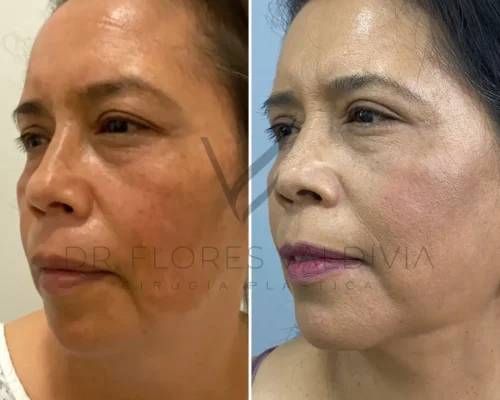 Side-by-side comparison of a woman's face before and after a cosmetic procedure, showing noticeable improvements in skin texture and tone.