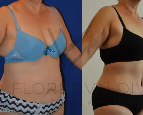 Abdominoplastia
