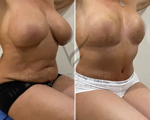 Side-by-side comparison of a person before and after a breast augmentation or lift surgery, wearing black underwear on the left and white underwear on the right, with noticeable changes in breast appearance.
