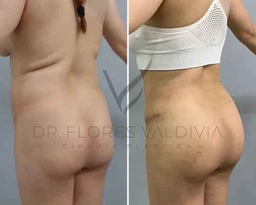 Side-by-side comparison image of a person before and after body contouring surgery. The before image shows the individual with a fuller figure, while the after image shows a more sculpted physique.