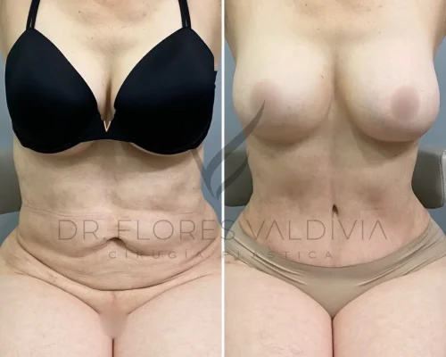 A woman is shown in a side-by-side comparison before and after a body transformation procedure, likely showing the results of a cosmetic surgery focused on the abdomen and breasts.
