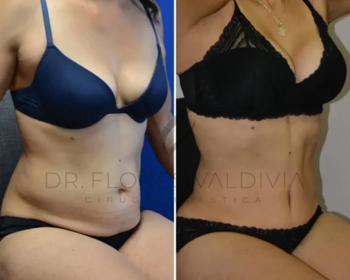 Side-by-side comparison showing a woman in dark underwear before (left) and after (right) a body transformation, highlighting improved abdominal and thigh areas. Text on image: "Dr. Florevaldivia Cirugía Plástica.