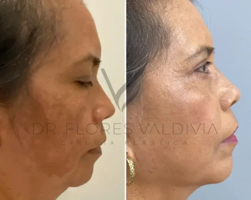 Side-by-side comparison of a woman's face before and after a cosmetic treatment, showing visible improvement in skin tone and texture. The text "Dr. Flores Valdivia Cirugía Plástica" is overlaid on the image.