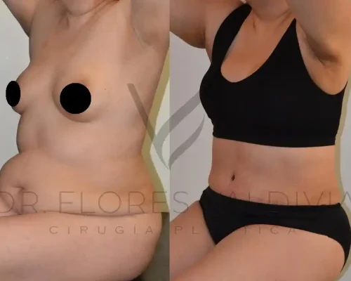 Abdominoplastia