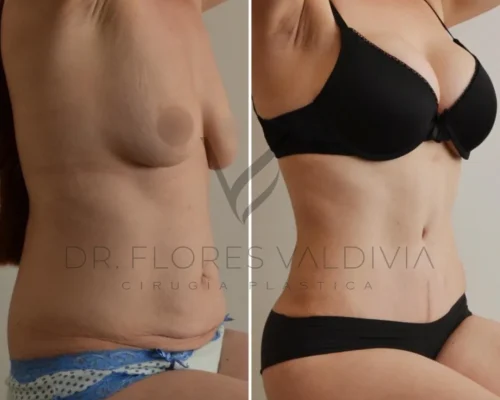 Side-by-side before and after photos of a person showing physical changes in their abdomen and chest region. Text on the image reads "Dr. Flores Valdivia, Cirugía Plástica.