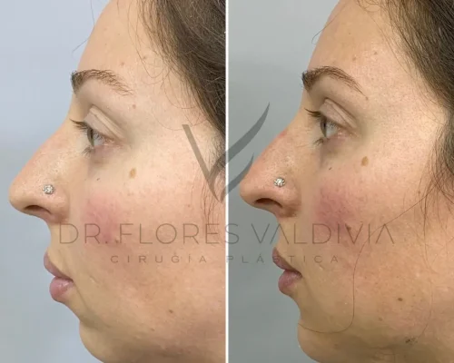 Side-by-side comparison of a woman's face before and after a rhinoplasty, showcasing changes to the nose shape. The image has the watermark of "Dr. Flores Valdivia Cirugía Plástica.