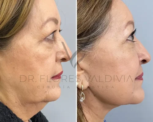 Before-and-after profile images of a woman showing the results of a cosmetic procedure. The left image is the "before," and the right image is the "after," with noticeable differences in facial contours.