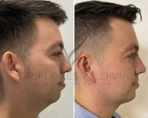 Side-by-side comparison of a man's face showing a before and after result of cosmetic surgery, with the after image displaying a more defined jawline and reduced double chin.