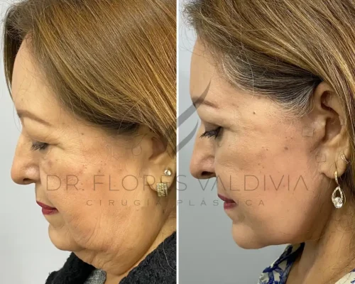 Side-by-side comparison of a woman's profile before and after a cosmetic procedure. The "before" image shows sagging skin, while the "after" image shows tighter, smoother skin.