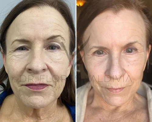 Side-by-side images of a woman's face before (left) and after (right) a cosmetic procedure showing noticeable reduction in wrinkles and skin tightening.