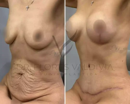 Abdominoplastia