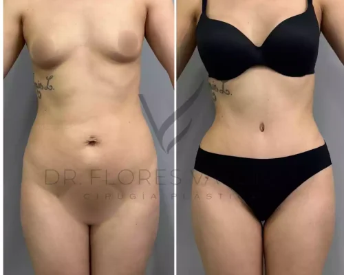 Abdominoplastia (41)