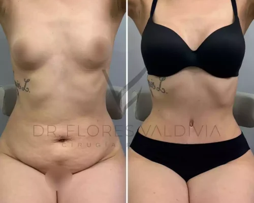 Abdominoplastia (42)