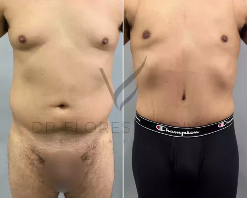 Abdominoplastia (47)
