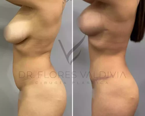 Abdominoplastia (50)
