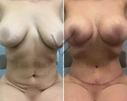 Abdominoplastia (51)