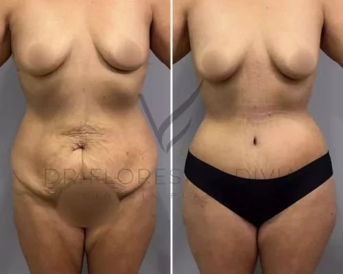 Abdominoplastia (52)