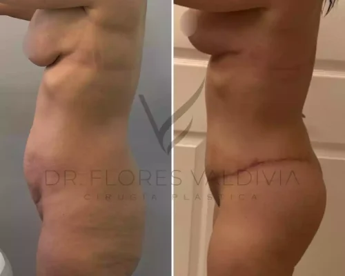 Abdominoplastia (55)