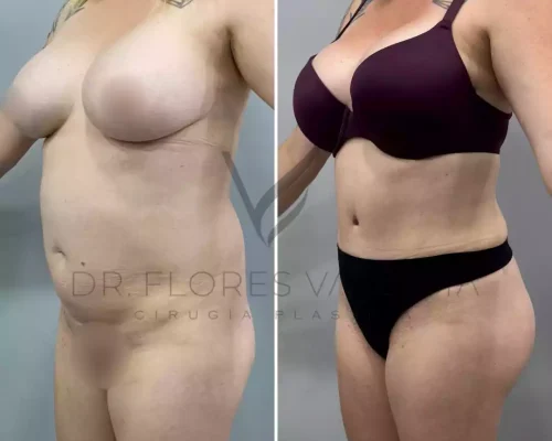 Side-by-side photos of a woman before and after cosmetic surgery, showing changes in body contour, clothing, and posture.