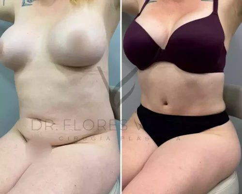 Side-by-side comparison of a woman before and after cosmetic surgery, showing changes in breast shape and abdominal contour.