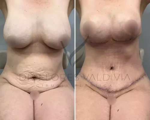 Side-by-side view of a woman before and after plastic surgery, showing changes to her breasts and abdomen, with visible surgical scars in the after image.