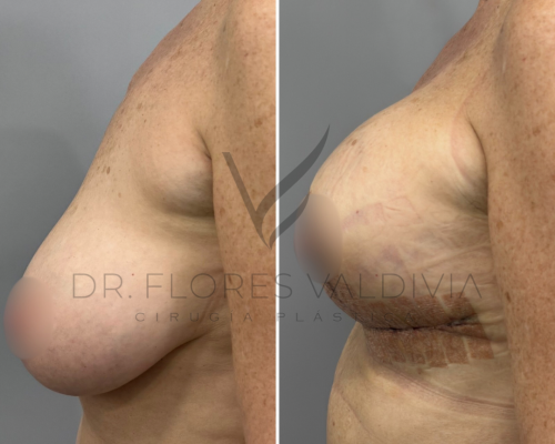Side-by-side comparison of a woman’s torso before and after breast lift surgery, showing changes in breast position and contour.