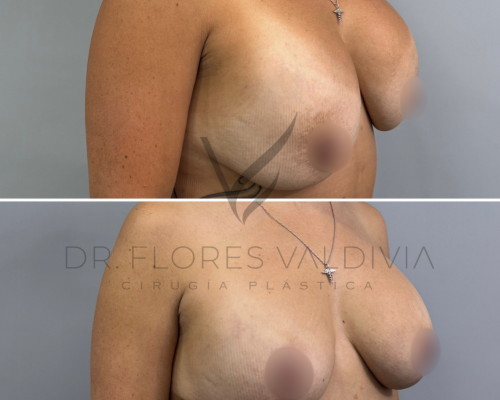Two side-by-side photos show a topless person’s torso before and after breast surgery with visible changes in breast shape and contour.
