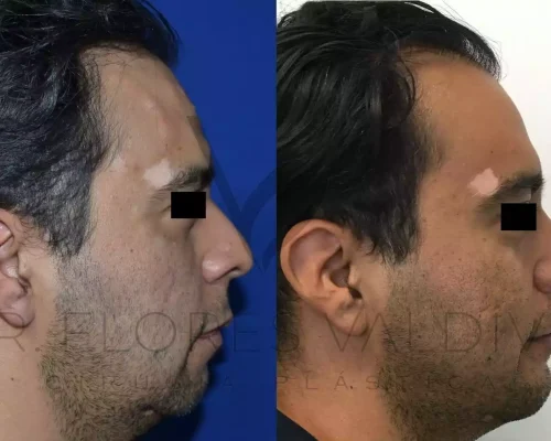 Mentoplastia