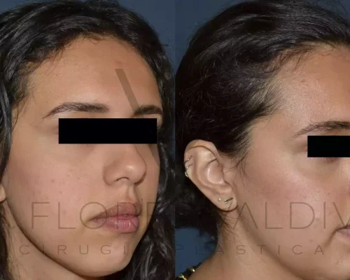 Mentoplastia