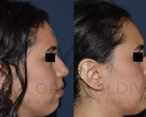 Mentoplastia