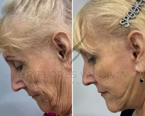 Side-by-side comparison of an older woman’s profile before and after a cosmetic procedure, showing reduced wrinkles and tighter skin in the after image.