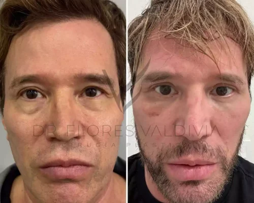 Ritidoplastia cervicofacial (18)