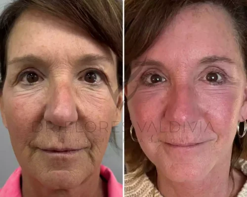 Ritidoplastia cervicofacial (22)
