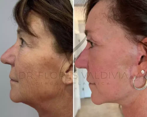 Ritidoplastia cervicofacial (23)