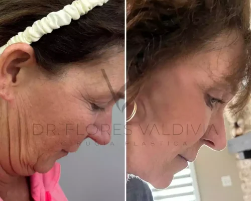 Ritidoplastia cervicofacial (24)