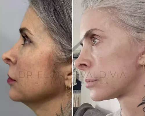 Ritidoplastia cervicofacial (25)