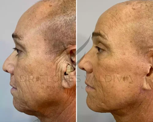Side-by-side profile photos of a middle-aged man before and after a cosmetic procedure, showing changes in skin texture and jawline definition.