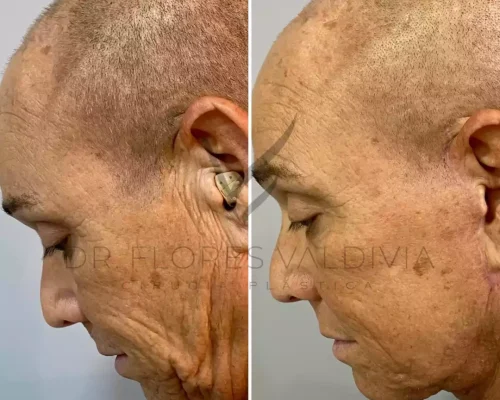 Side-by-side comparison of an older person’s profile before and after a cosmetic procedure, showing reduced wrinkles and tighter skin on the face and neck.