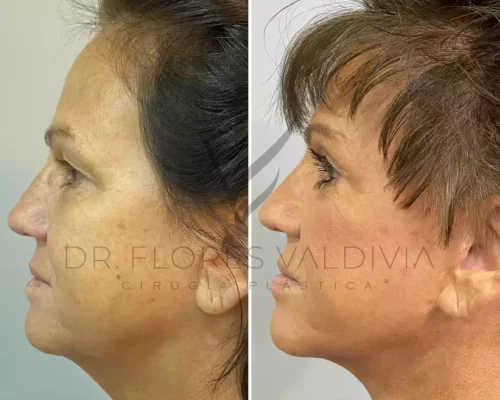 Side-by-side profile photos of a woman before and after facial cosmetic surgery, showing visibly tighter skin and a more defined jawline in the after image.