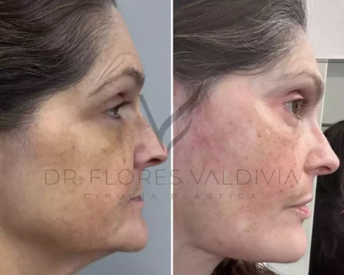 Side-by-side profile photos of a woman before and after a cosmetic procedure, showing reduced facial sagging and improved skin texture.