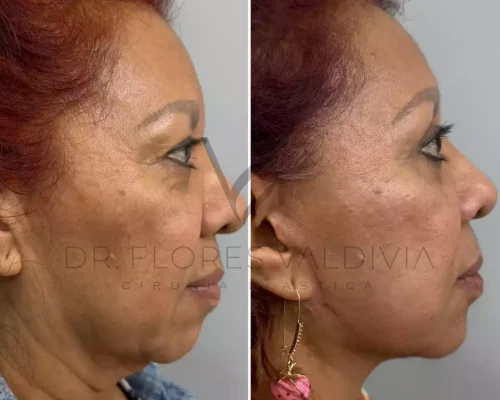 Side-by-side profile photos of a woman before and after a cosmetic procedure, showing smoother skin and reduced wrinkles in the after image.